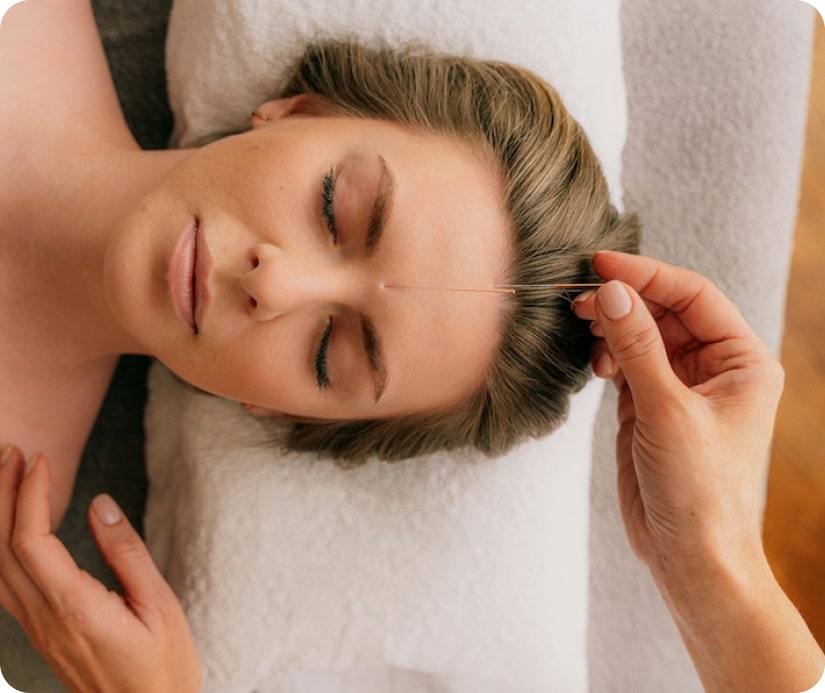 Person receiving acupuncture needle on forehead while lying on a towel with eyes closed.