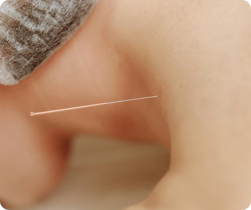 A close-up of an acupuncture needle inserted into a person's skin near the ankle.