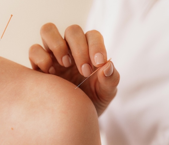 A hand inserts an acupuncture needle into a person's shoulder.