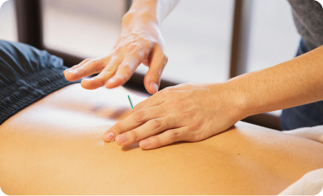 Hands inserting an acupuncture needle into a person's bare back.