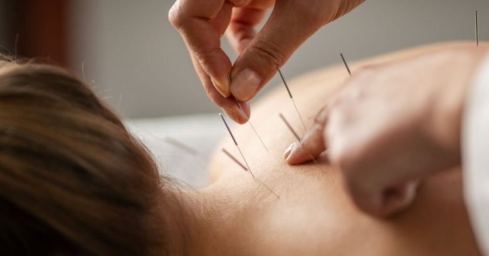 An acupuncture session focused on back pain, showing needles placed along the spine, highlighting first-time experiences.