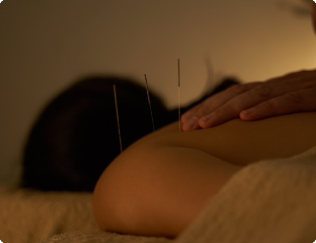 Person receiving acupuncture on their back with a hand resting on their shoulder.