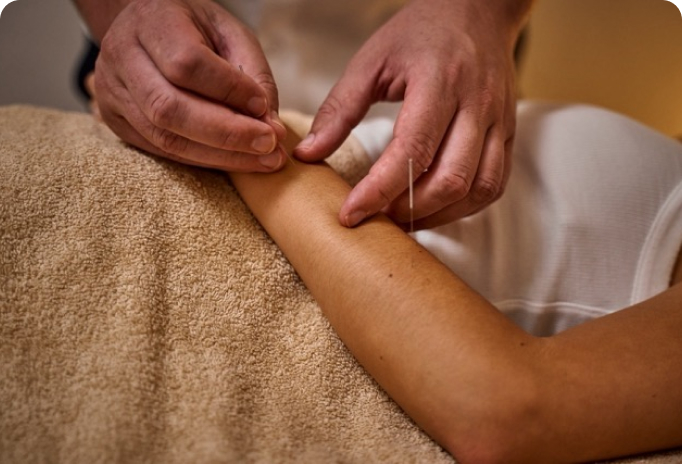 Close-up of a person receiving acupuncture needles in their forearm while lying on a towel.