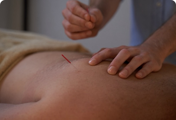 A person inserts an acupuncture needle into another person's bare back.