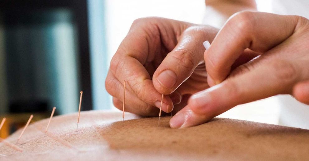 Close-up of a person experiencing the benefits of regular acupuncture with needles in their back.