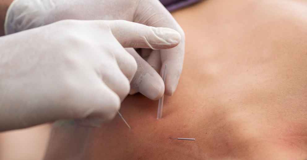 Gloved hands inserting acupuncture needles, demonstrating how acupuncture boosts sperm quality.