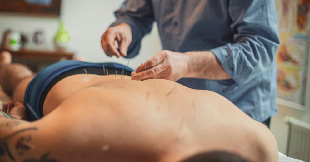 Person receiving acupuncture for executive stress management with needles in their bare back.