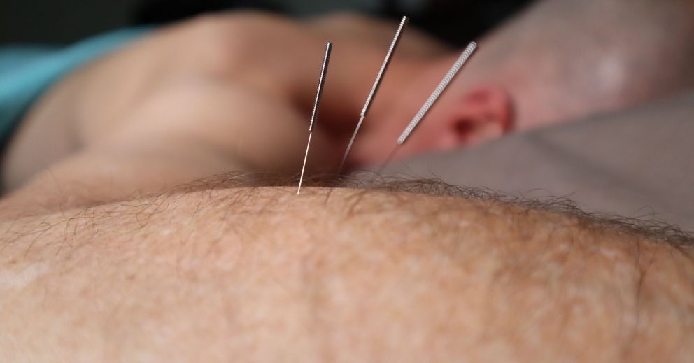 Three dry needling acupuncture needles inserted into a person’s skin.